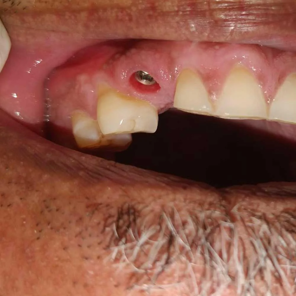 Dental Implants