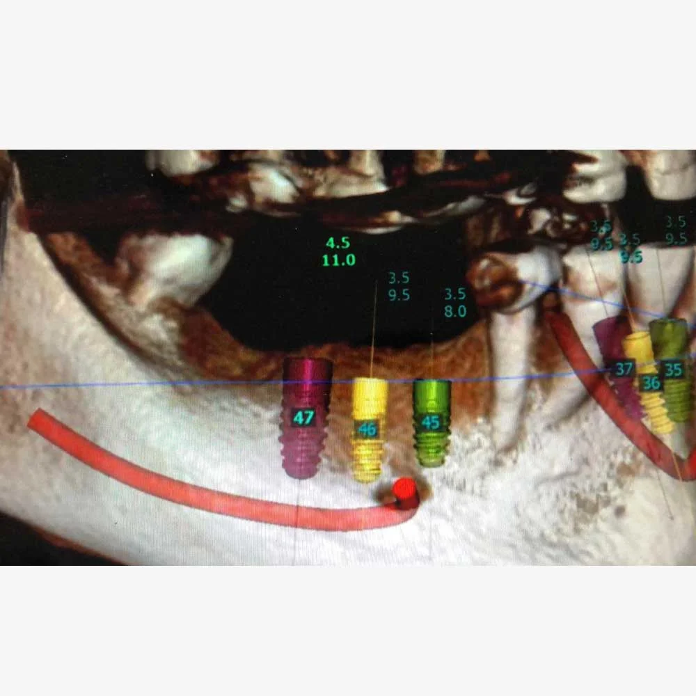 Dental Implants