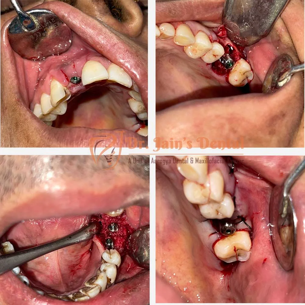 Immediate Dental Implants