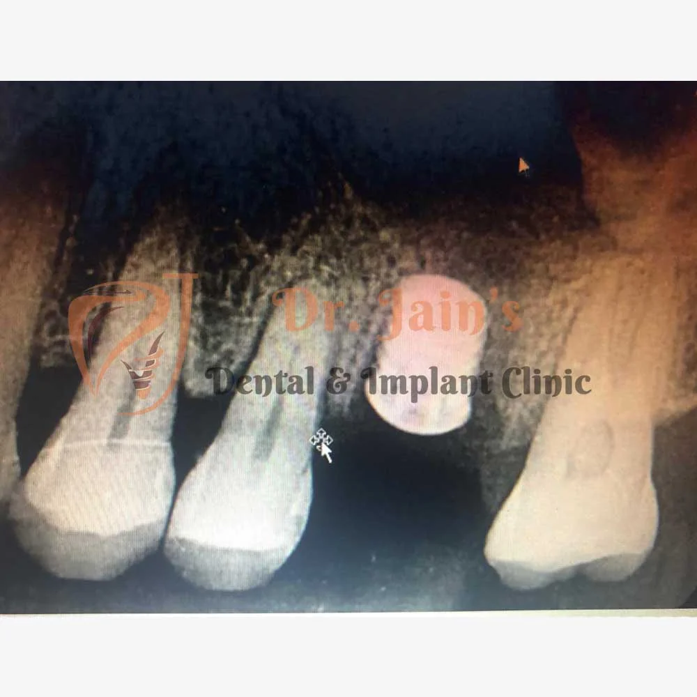 Dental Implants