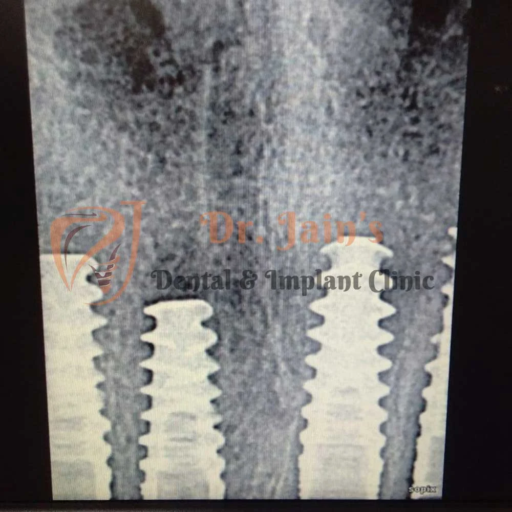 Dental Implants