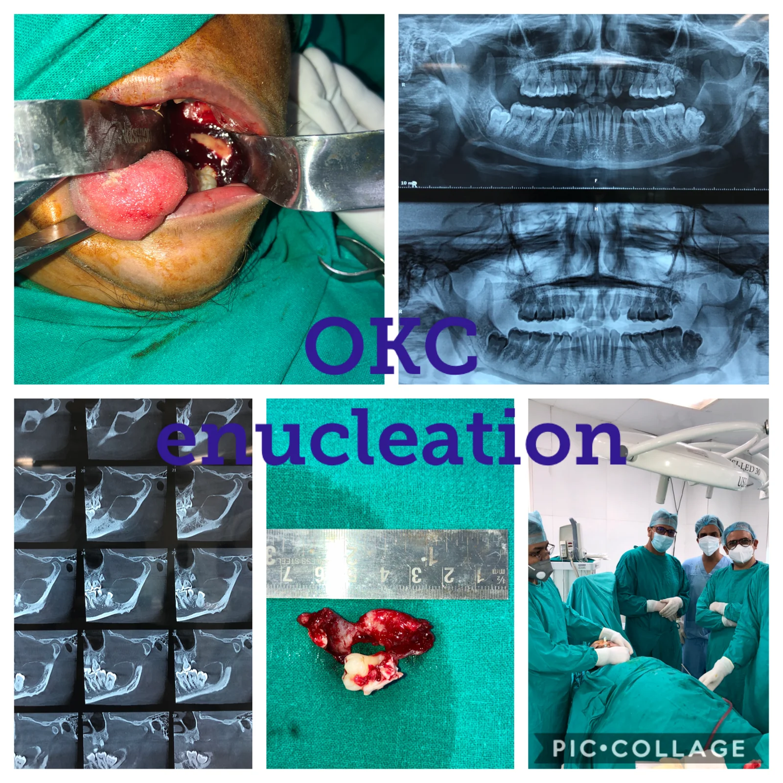 Cysts and Tumor